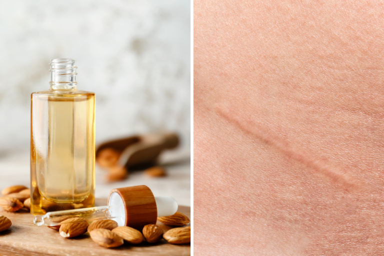 almond oil for scars