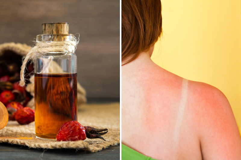 rosehip oil for sunburn